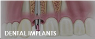 dental implants fresno ca