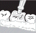 Illustration: The tooth is dried, and cotton is put around the tooth so it stays dry.