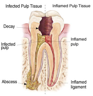 Mankirat Gill does root canal