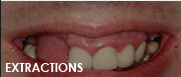 extractions dentist fresno ca