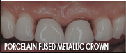 porcelain fused metallic dentist fresno ca