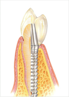 dental implants