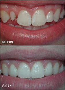 Gum Contouring