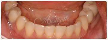 teeth whitening fresno ca