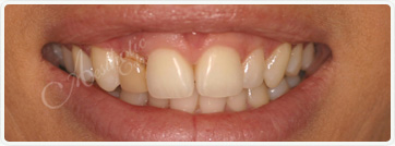 gum contouring fresno ca