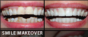 smile makeover