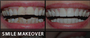 smile makeover fresno ca