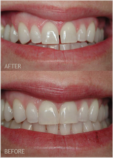 Bonding Fresno Dentist