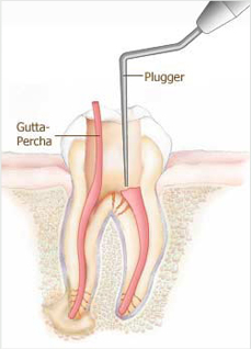 Root canal treatment Fresno CA