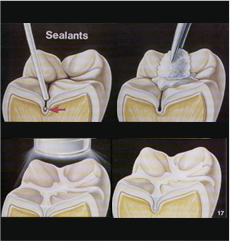 Sealants Fresno CA