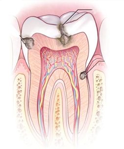 Fillings Fresno CA