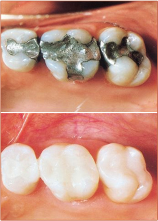 Tooth Colored Fillings